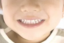 小児期の矯正治療（床矯正・咬合誘導）のイメージ