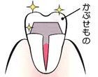 治療の流れのイメージ